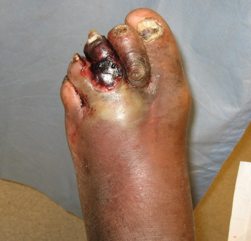 DMgas_gangrene