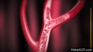 3D_Medical_Animation_HD_Stroke_Management.gif